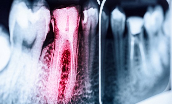 An X-ray of an infected tooth