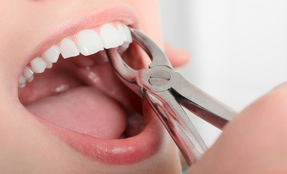 A tooth being extracted by a dentist