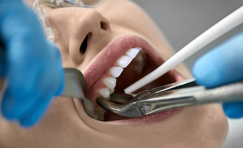 Closeup of woman’s tooth being grasped by forceps for extraction.