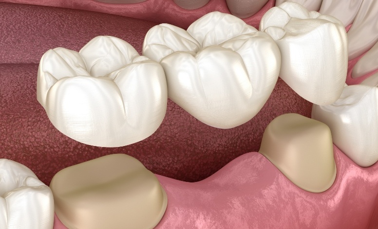 Animated smile during fixed bridge placement