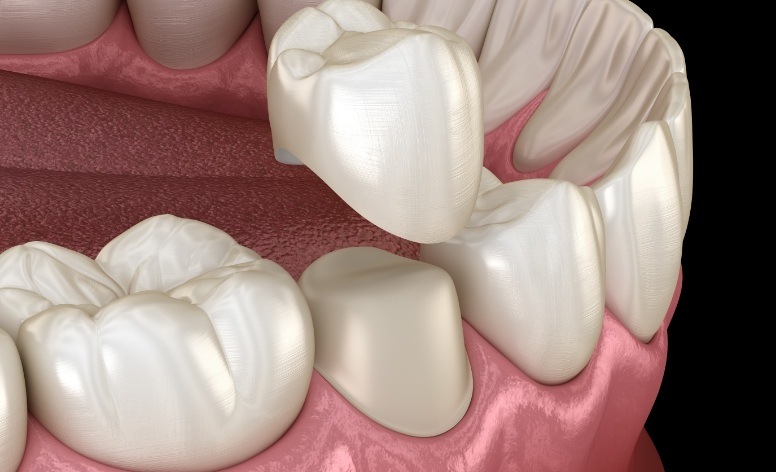 Animated smile during dental implant placement