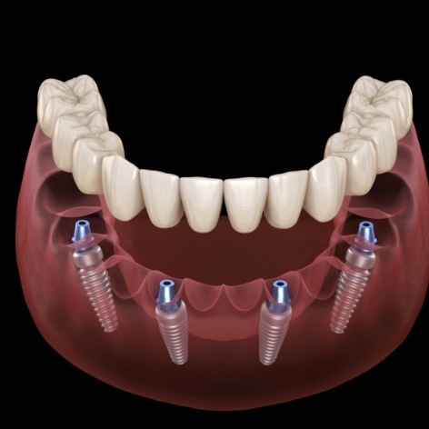 Animated smile during dental implant supported denture placement