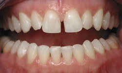 Closeup of smile with gaps between teeth