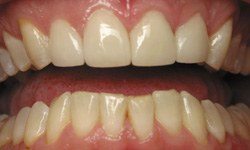 Healthy happy smile after restorative dentistry