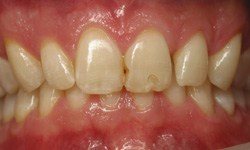 Damaged and decayed smile before restorative dentistry
