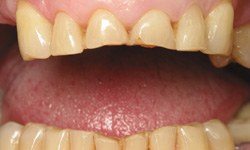 Worn teeth dental treatment