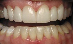 Healthy white smile after cosmetic dentistry