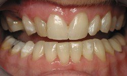 Discolored teeth before cosmetic dentistry