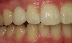 Full healthy smile after tooth replacement