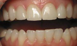 Healthy gorgeous smile after cosmetic dentistry