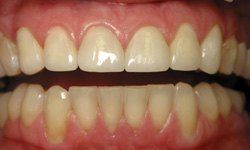 Healthy bright smile after dental restoration