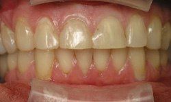 Discolored and damaged smile before dental restoration