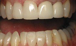 Smile after chipped teeth are repaired
