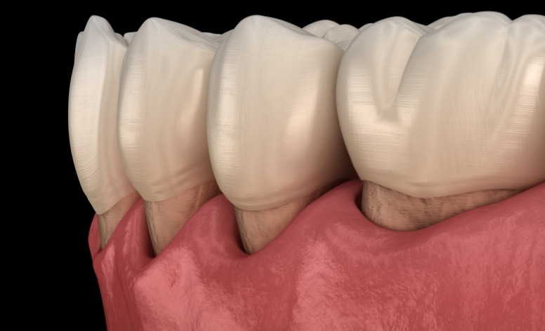 Animated smile with receding gum tissue caused by gum disease