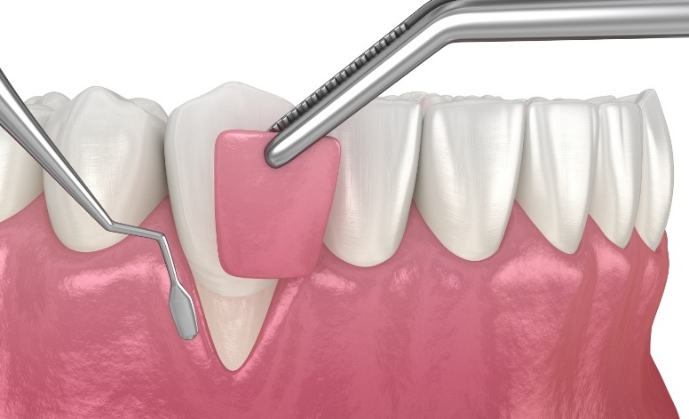 Animated smile during surgical gum grafting treatment