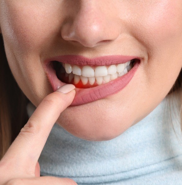 Woman pointing to smile after gum lift treatment