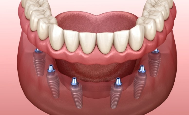 A digital image of 8 dental implants and a full denture along the lower arch in Fort Worth