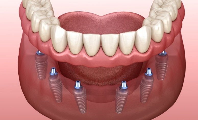 Animated smile during dental implant denture placement