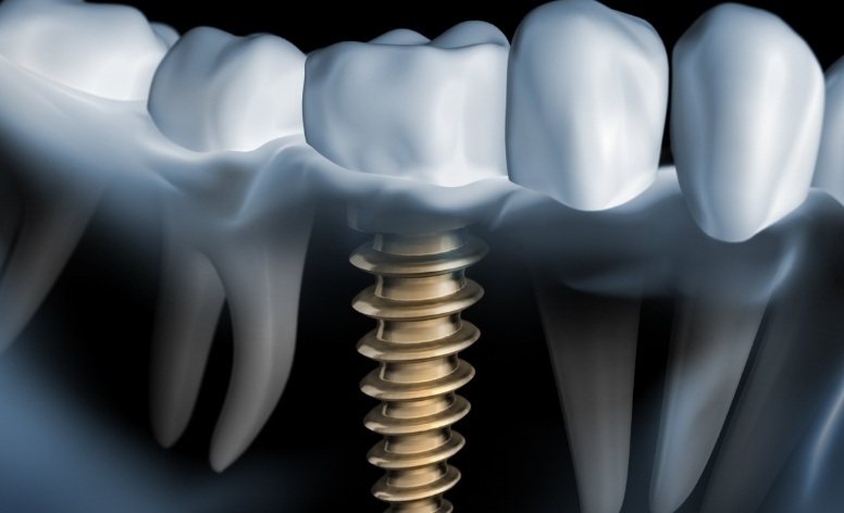 Animated smile with dental implant supported replacement tooth