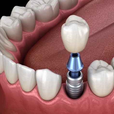 Animated smile during dental implant supported dental crown placement