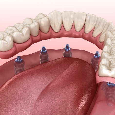 Animated smile during dental implant supported denture placement