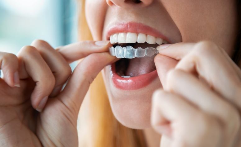 Closeup of patient placing an Invisalign tray