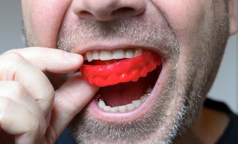Dental patient placing an athletic mouthguard