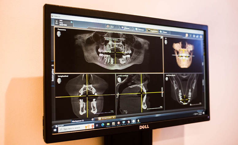 Two women smiling together after oral and gum tissue surgery