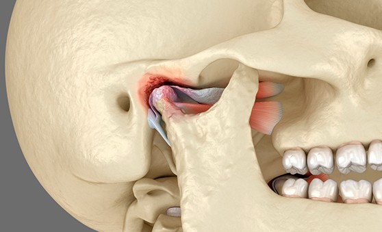 A CGI model of a skull highlighting the temporomandibular joints