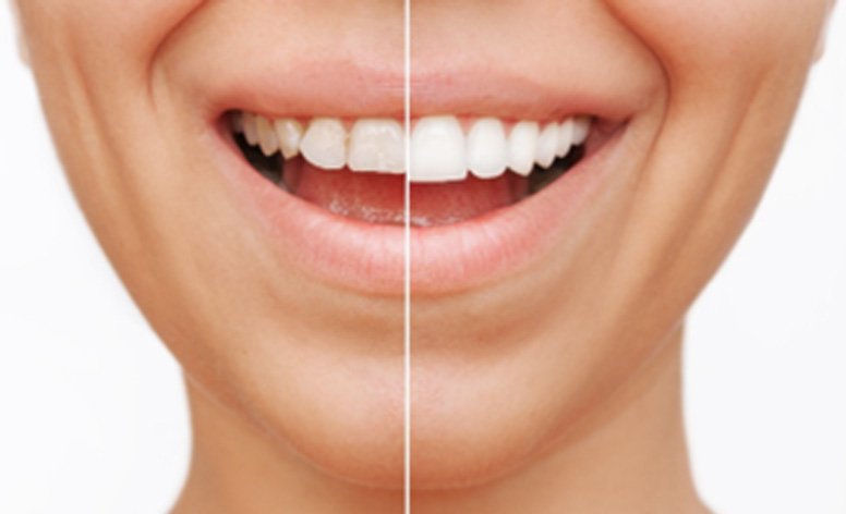 Closeup of patient's smile before and after veneers