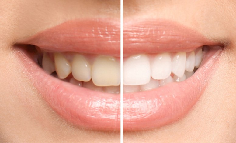 Teeth whitening before & after