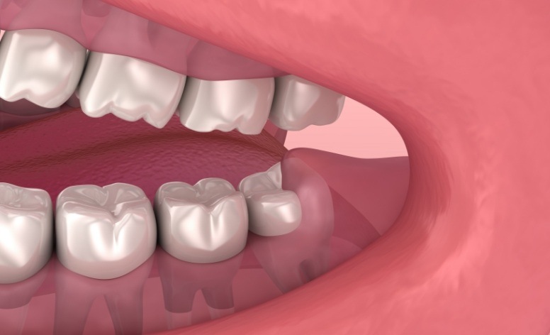 Animated smile in need of wisdom tooth extraction