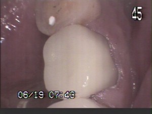 cerec-after1of1