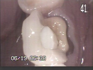 cerec-before1of11