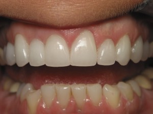 Longer, more natural and younger-looking teeth