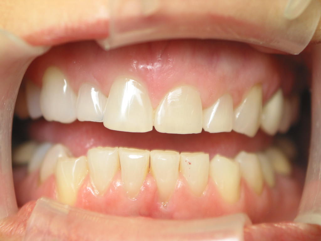 Lengthening Short Teeth Fort Dental