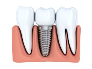 Dental implants in Fort Worth replace teeth and strengthen the jaw. Are they a suitable prosthetic for you? Find out from the experts at Fort Dental. 