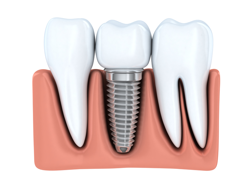 Dental implants in Fort Worth replace teeth and strengthen the jaw. Are they a suitable prosthetic for you? Find out from the experts at Fort Dental.