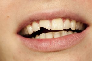 Emergency dentist in Fort Worth repairs chipped teeth