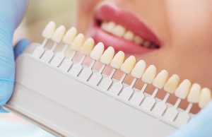 veneers color matching guide