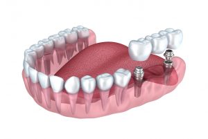 implant denture illustration