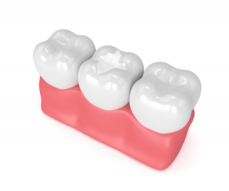 Do Fillings Need To Be Replaced Tooth Colored Hulen Dental