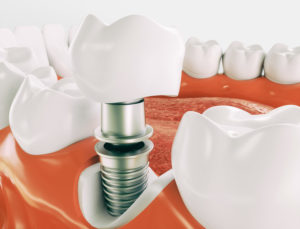 Model of dental implant pieces in mouth