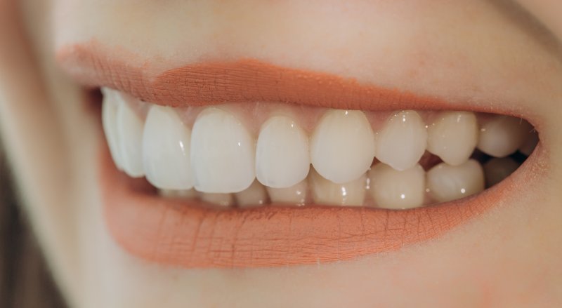 Porcelain veneers