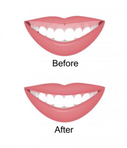 gummy smile before and after illustration 