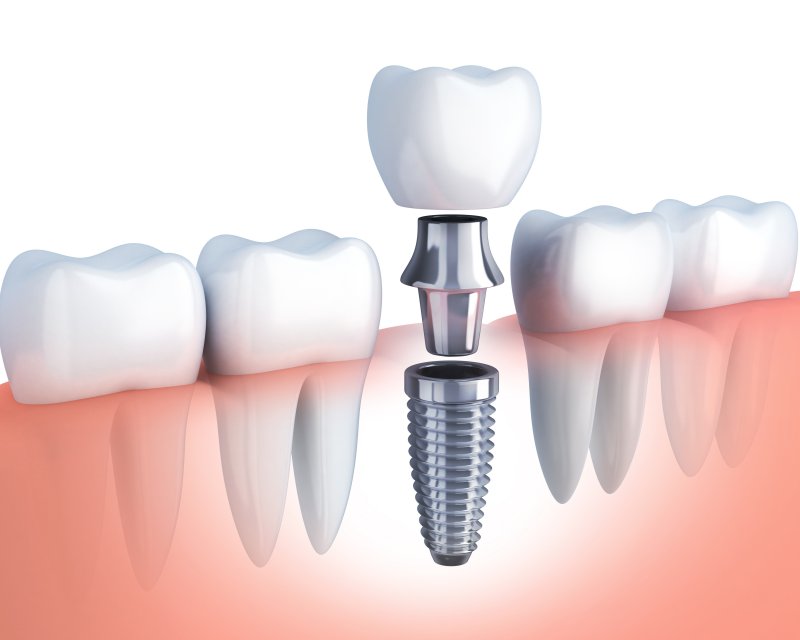 Closeup of a dental implant