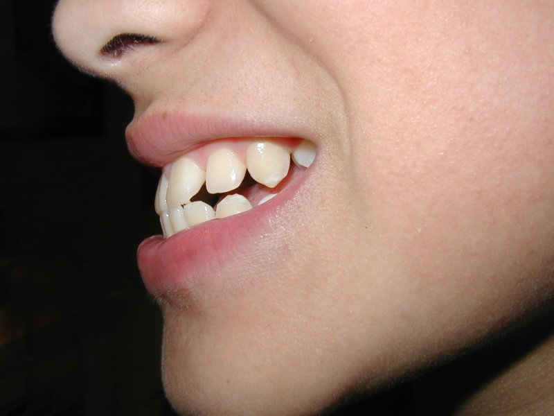 Dental patient with an overbite