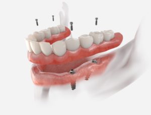 CGI illustration of dentures with dental implants in front of a white background