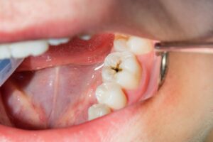 Tooth cavity pictured.