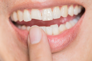 Close-up of smile with broken tooth